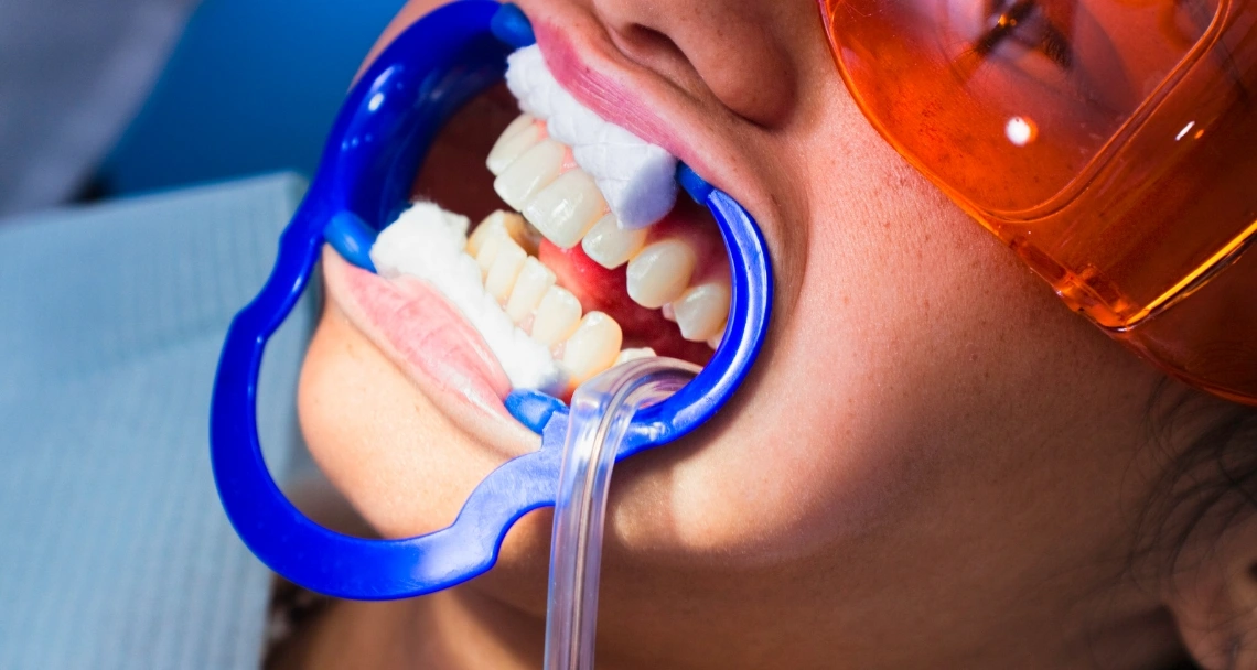 Teeth-Whitening-Light-Treatment-Preparation